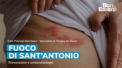 il fuoco di sant'antonio è contagioso